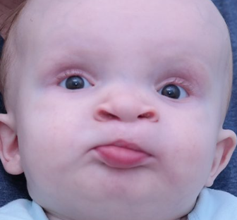 After Cleft Palate Surgery