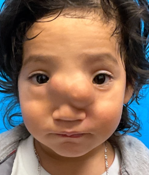 Before Craniofacial Surgery