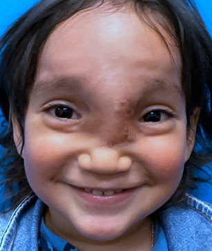 After Craniofacial Surgery