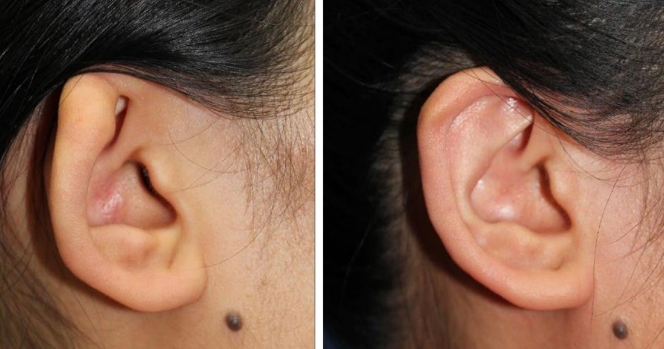 Pinna Reconstruction After