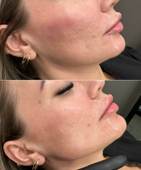 Dermal Filler Jawline