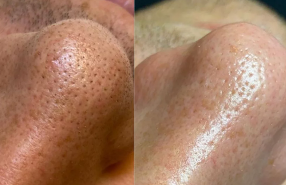 Hydrafacial Example 2