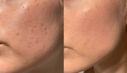 Microdermabrasion Texture