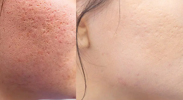 Chemical Peel Acne Marks