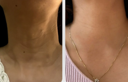 Skin Tightening Neck
