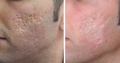 Skin Resurfacing Acne Scars