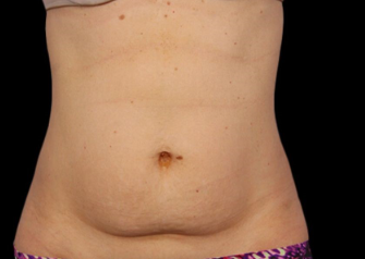 Before Fat Freezing