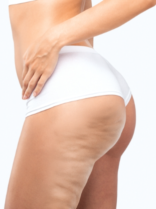 Before Cellulite Reduction