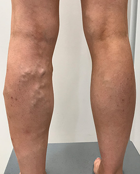 Before Sclerotherapy