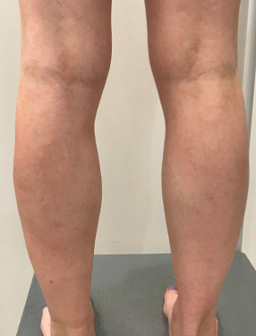 After Sclerotherapy