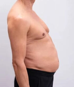 Before Weight Loss Injections