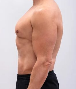 After Weight Loss Injections