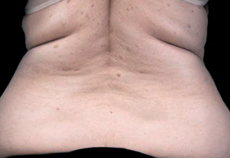 Before Fat Reduction