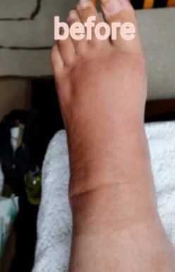 Before Lymphatic Drainage