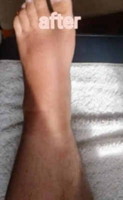 After Lymphatic Drainage