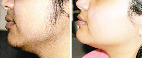 Laser Hair Removal 2