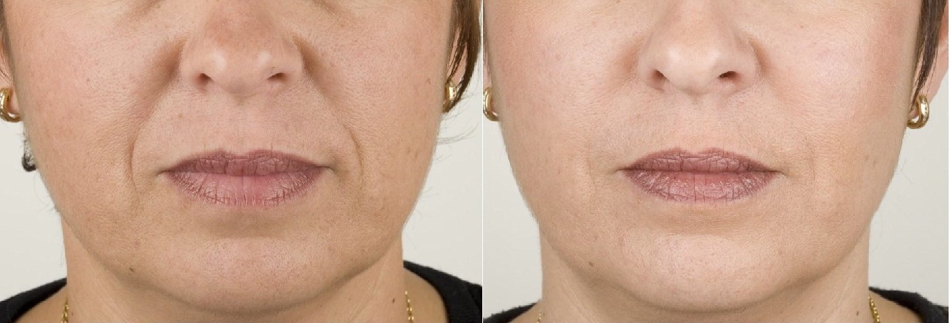 Microdermabrasion Bright Skin