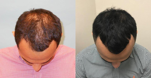 Hair Loss Treatment 2