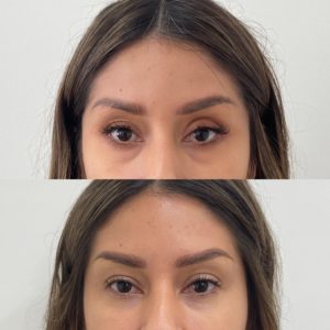 Dermal Filler Under Eye