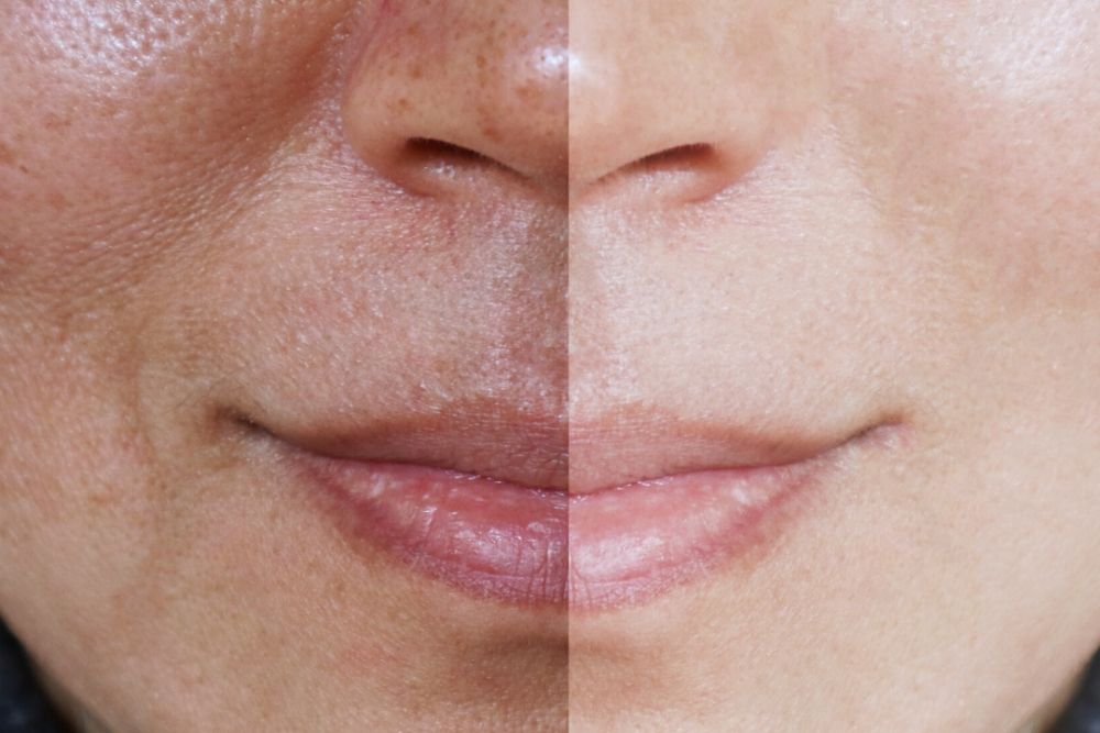 Skin Lightening Face