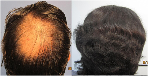 Hair Transplant Before After 2