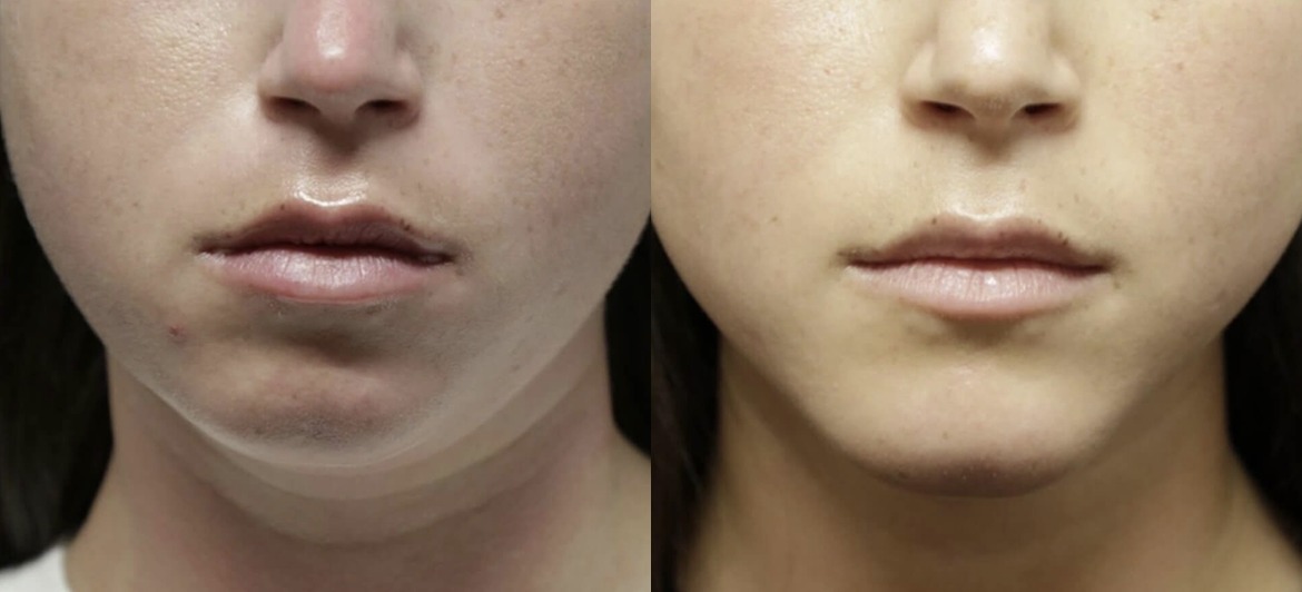Chin Reshaping Result