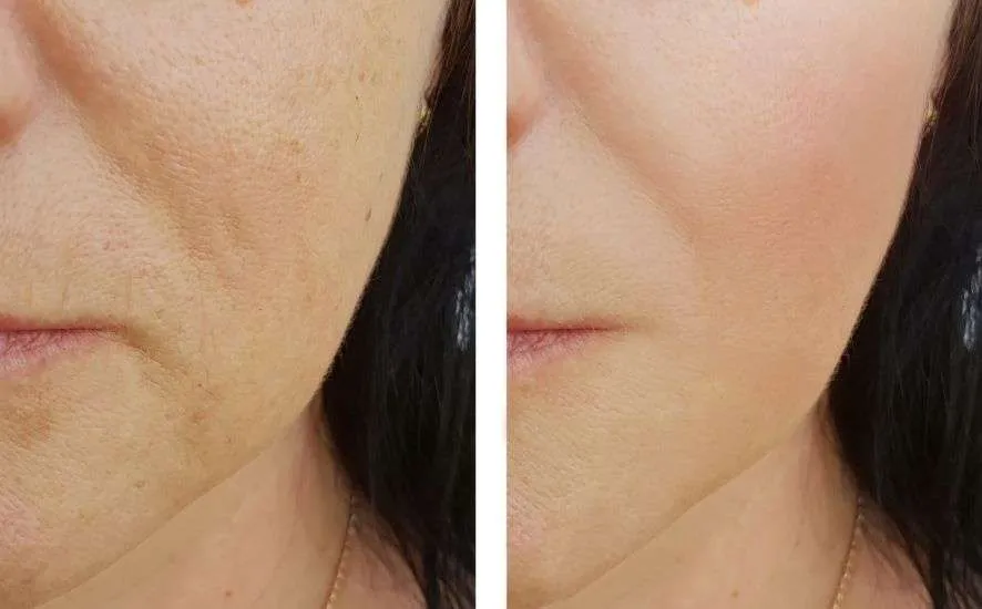 Collagen Boosting Before and After 1