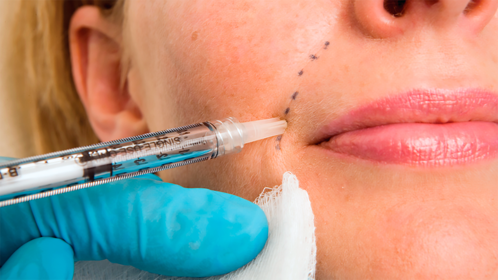 Dermal Filler Injections at Vilva Cosmetics