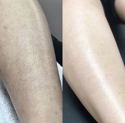 Laser Hair Removal 3