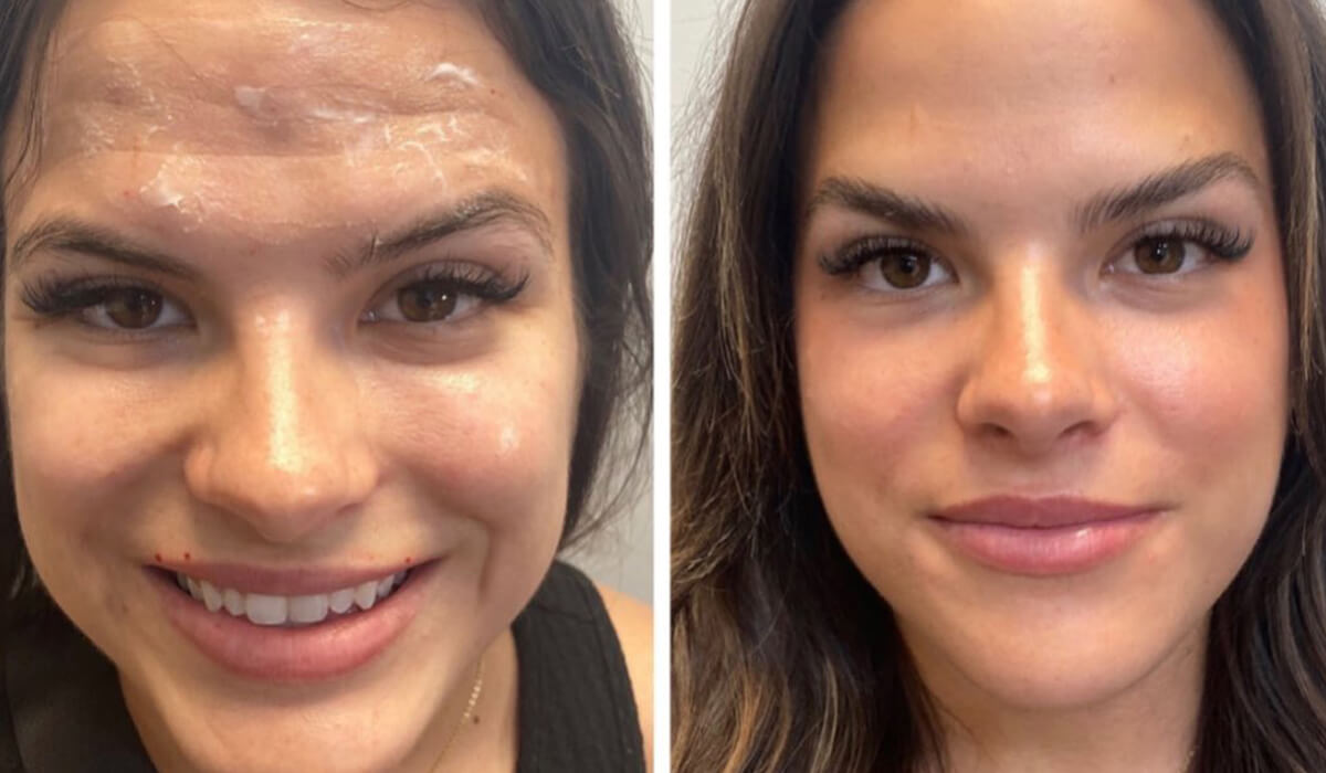 Botox Before and After 3