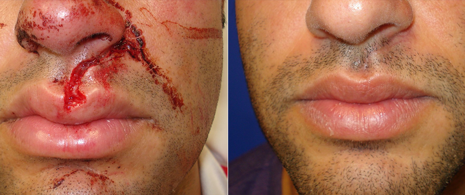 Facial Trauma Case 1