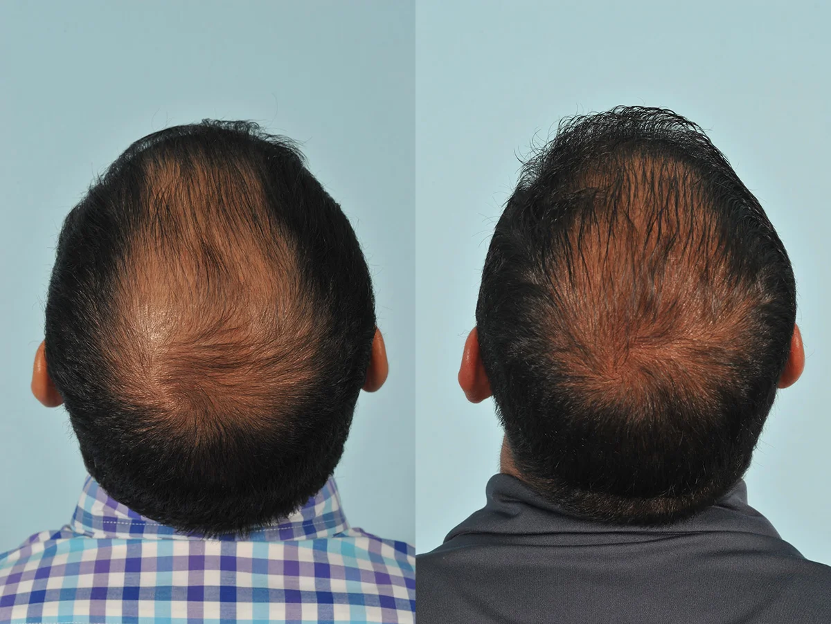 Hair Transplant Before After 1