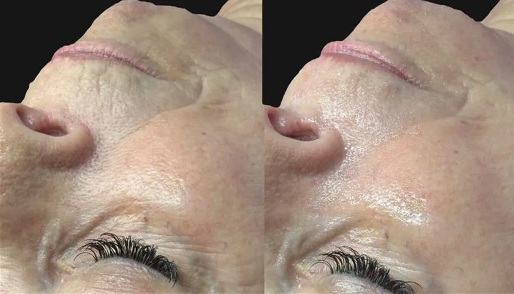 Hydrafacial Example 3