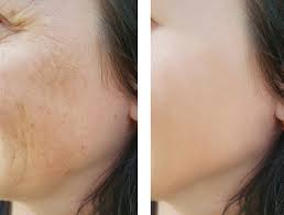 Chemical Peel Pigmentation