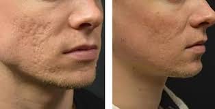 Microneedling Acne Scars