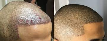 Hair Transplant Before After 3