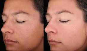 Obagi Skin Peel Brightness