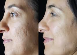 Microdermabrasion Acne Marks