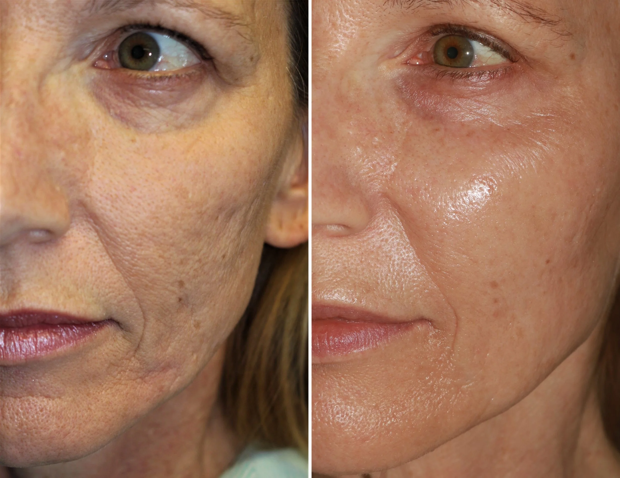 Microneedling Fine Lines