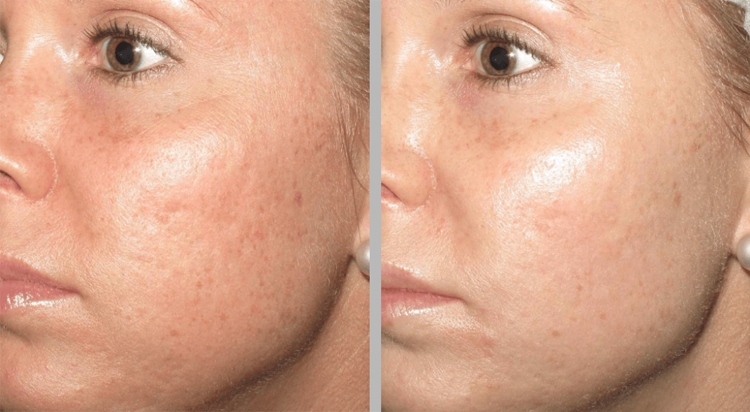 Microneedling Skin Texture
