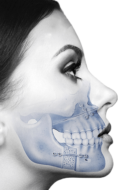 Orthognathic surgery