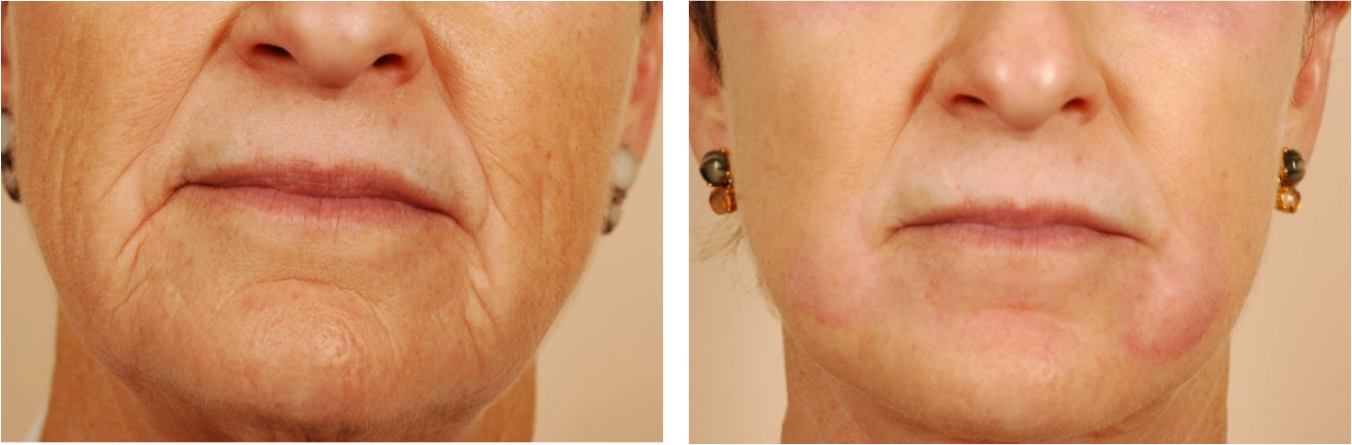 Croton Oil Peel Wrinkles