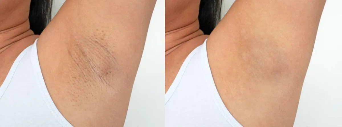 Laser Hair Removal 1
