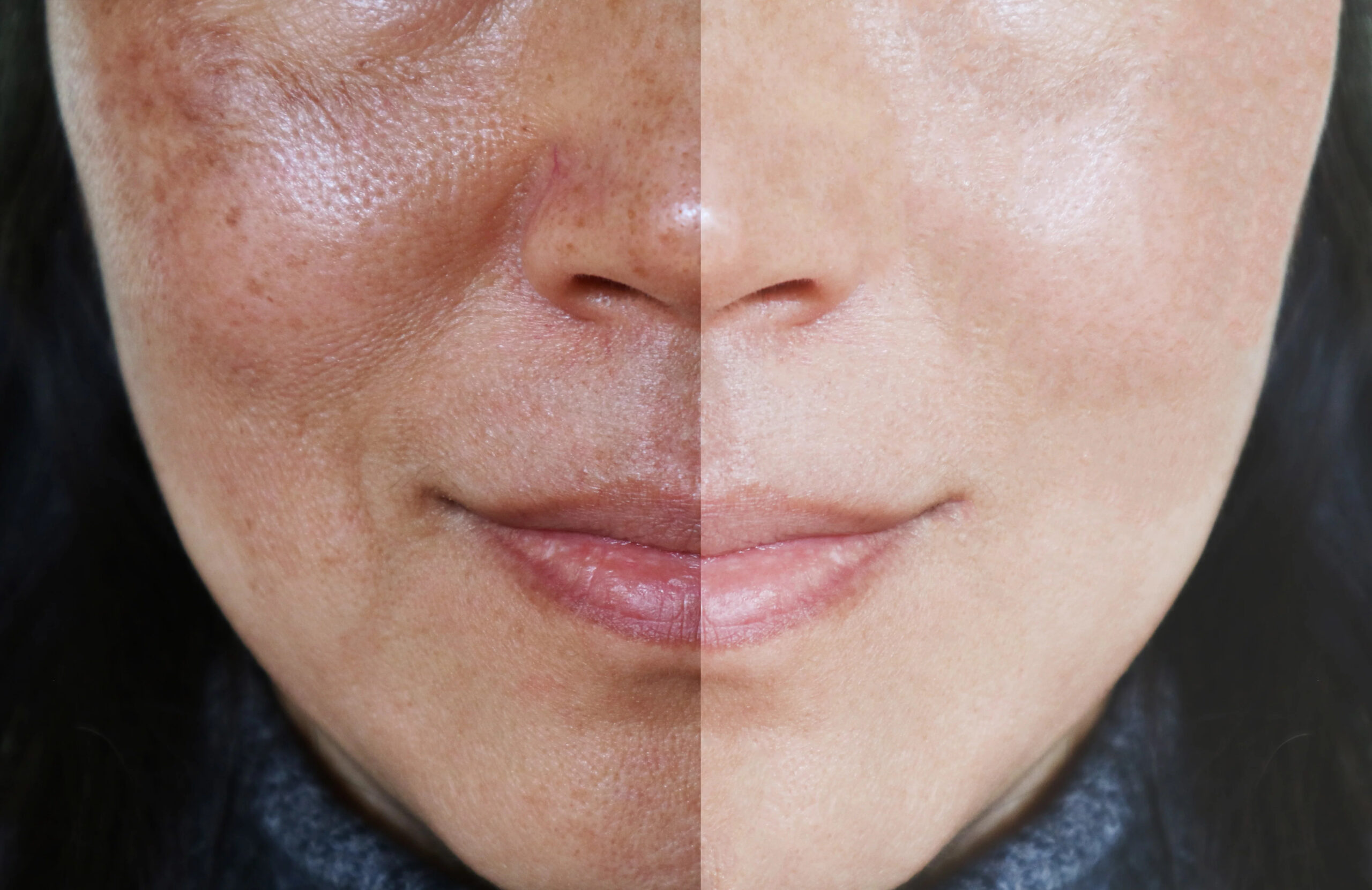 Croton Oil Peel Pigmentation