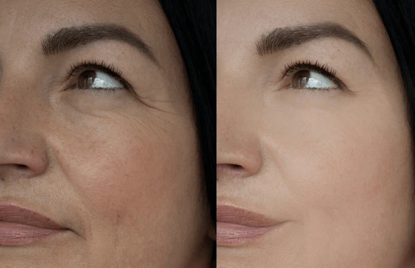 Collagen Boosting Before and After 3